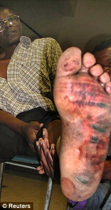 Beatings: A member of Zimbabwe opposition party Movement for Democratic Change displays his injuries at the hands of Mugabe thugs (file picture)